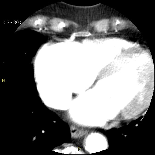 Aortoiliac occlusive disease (Radiopaedia 16828-16548 A 30).jpg