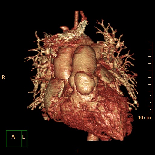 File:Aortopulmonary septal defect (Radiopaedia 41990-45013 3D reconstruction 2).jpg