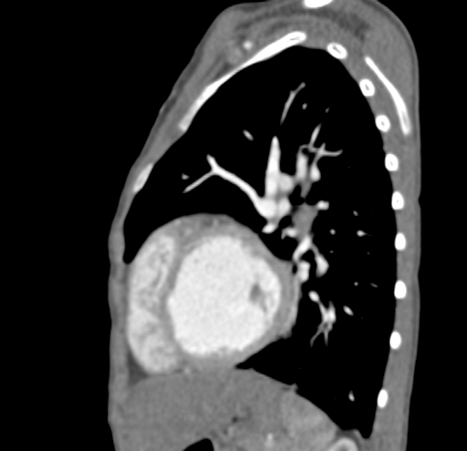 File:Aortopulmonary window, interrupted aortic arch and large PDA giving the descending aorta (Radiopaedia 35573-37074 C 39).jpg