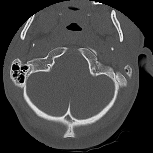 File:Apical pneumothorax on cervical spine CT (Radiopaedia 45343-49368 Axial bone window 6).jpg