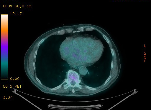 Appendiceal adenocarcinoma complicated by retroperitoneal abscess (Radiopaedia 58007-65041 Axial PET-CT 86).jpg