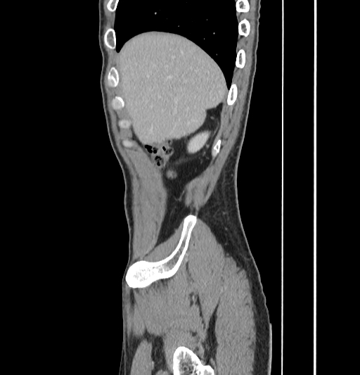 Appendiceal mucinous adenocarcinoma (Radiopaedia 66605-75922 C 8).jpg