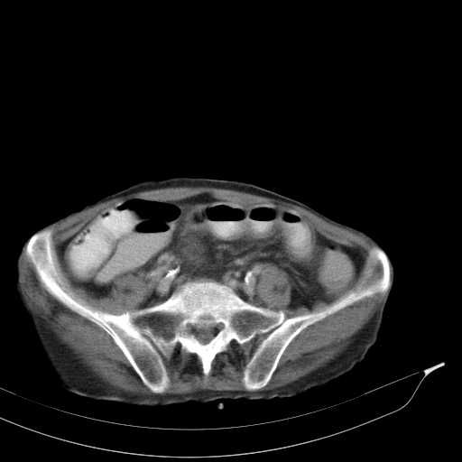 File:Appendiceal mucocoele due to adjacent cecal tumor (Radiopaedia 20478).jpg