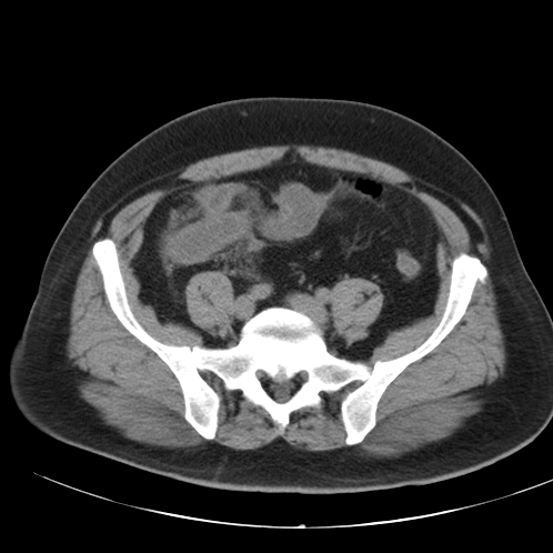 Appendicitis and giant appendicolith (Radiopaedia 80251-93588 Axial non-contrast 42).jpg