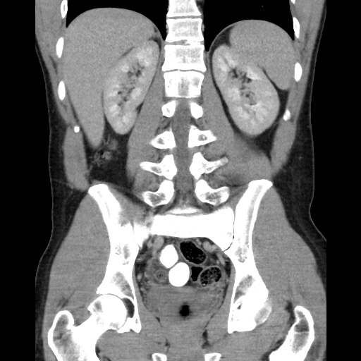 File:Appendicitis complicated by post-operative collection (Radiopaedia 35595-37113 B 37).jpg