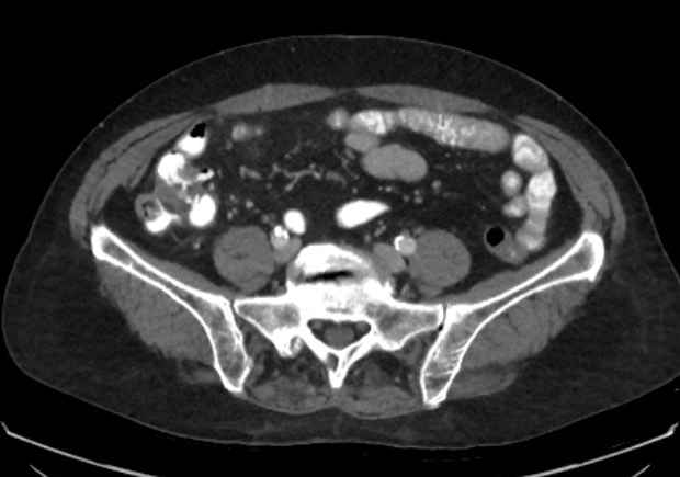 File:Appendicitis due to chicken fibula (Radiopaedia 74314-85198 A 15).jpg
