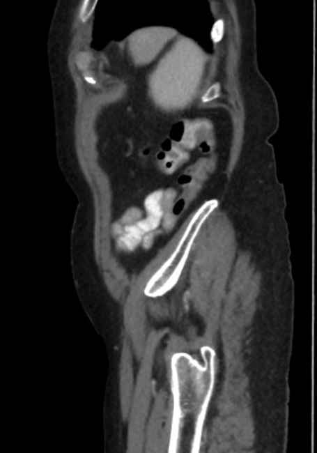 Appendicitis due to chicken fibula (Radiopaedia 74314-85198 C 90).jpg