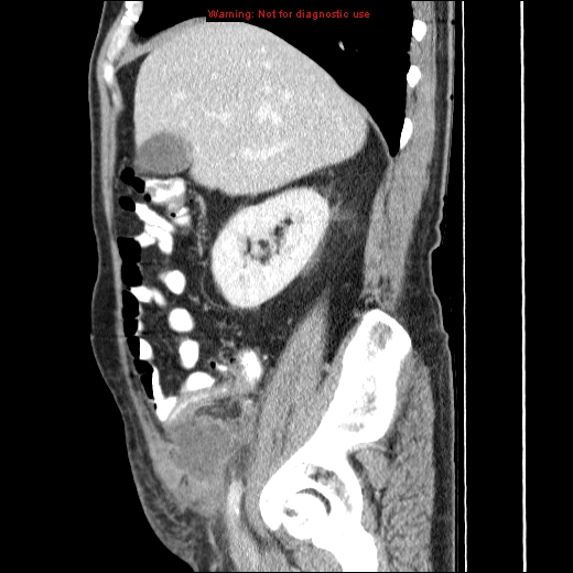 File:Appendicitis mass in inguinal hernia (Radiopaedia 26858-27029 C 14).jpg