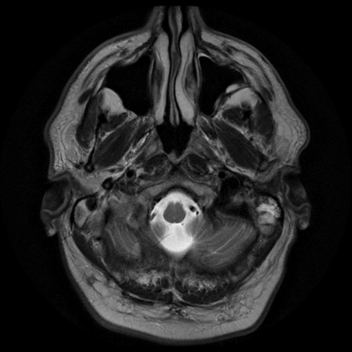 File:Aqueduct stenosis with corpus callosum hypoattenuation post shunting (Radiopaedia 37212-38969 Axial T2 1).png