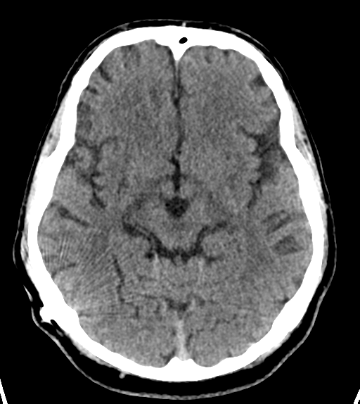 File:Aqueduct stenosis with corpus callosum hypoattenuation post shunting (Radiopaedia 37212-38971 Axial non-contrast 12).png