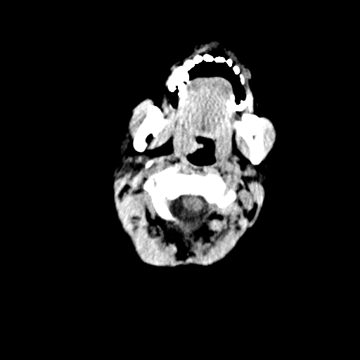Arachnoid cyst-posterior fossa (Radiopaedia 88661-105370 Axial non-contrast 4).jpg