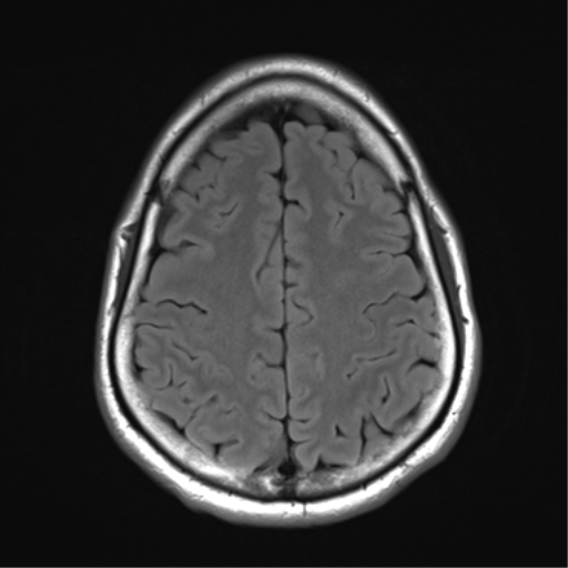 File:Arachnoid cyst - cerebellopontine angle (Radiopaedia 59689-67083 Axial FLAIR 29).png