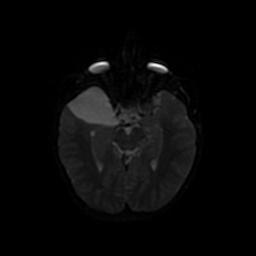 Arachnoid cyst - middle cranial fossa (Radiopaedia 67671-77088 Axial DWI 38).jpg