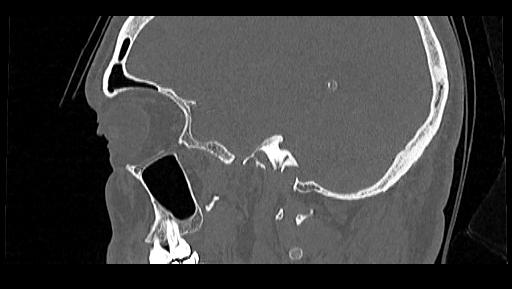 Arcuate foramen (Radiopaedia 89833-106944 Sagittal bone window 110).jpg