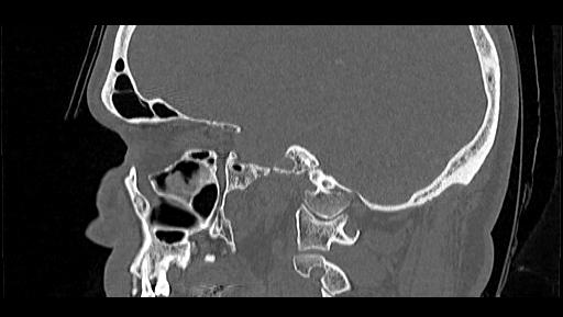 Arcuate foramen (Radiopaedia 89833-106944 Sagittal bone window 24).jpg