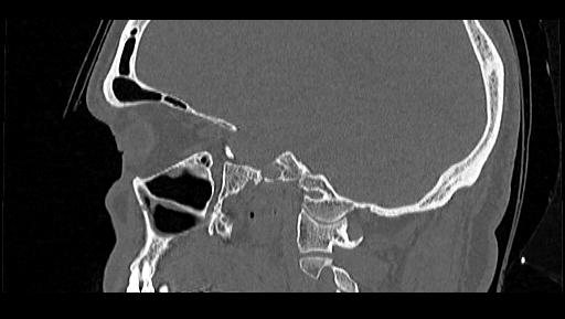 Arcuate foramen (Radiopaedia 89833-106944 Sagittal bone window 91).jpg