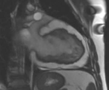 File:Arrhythmogenic right ventricular cardiomyopathy (Radiopaedia 69431-79307 2ch cine 33).jpg