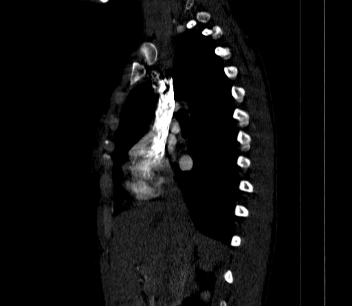 Arteria lusoria (Radiopaedia 88528-105192 C 43).jpg