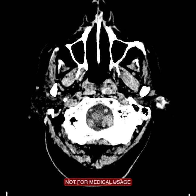 Artery of Percheron infarction (Radiopaedia 28679-28967 Axial non-contrast 8).jpg