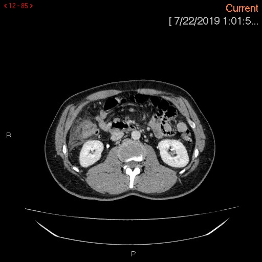 File:Ascending colonic diverticulum mimicking acute appendicitis (Radiopaedia 69943-80198 A 85).jpg