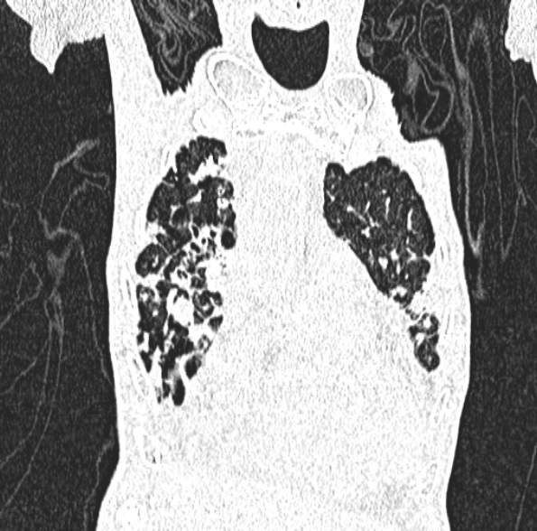 Aspergilloma- with Monod sign (Radiopaedia 44737-48532 Coronal lung window 153).jpg