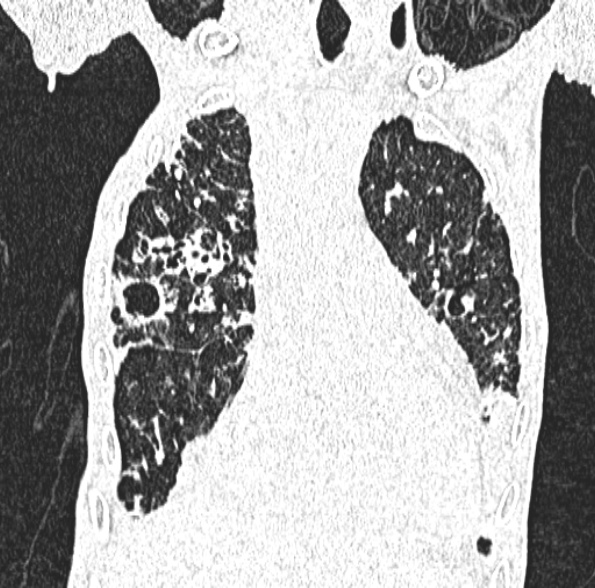 Aspergilloma- with Monod sign (Radiopaedia 44737-48532 Coronal lung window 182).jpg