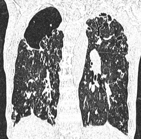 Aspergilloma- with Monod sign (Radiopaedia 44737-48532 Coronal lung window 314).jpg