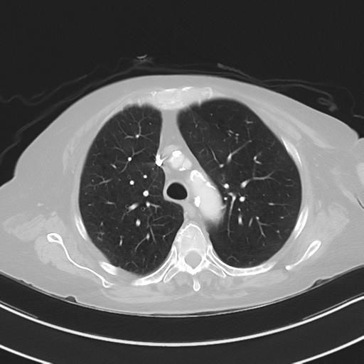 Aspiration bronchiolitis (Radiopaedia 53464-59463 Axial lung window 16).png