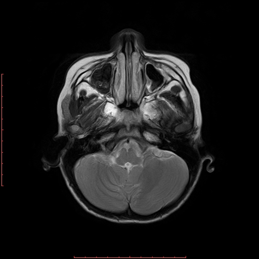 File:Astroblastoma (Radiopaedia 74287-85162 Axial T2 3).jpg