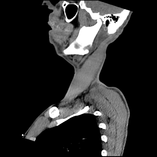 File:Atlanto-occipital dissociation (Traynelis type 1), C2 teardrop fracture, C6-7 facet joint dislocation (Radiopaedia 87655-104061 D 17).jpg