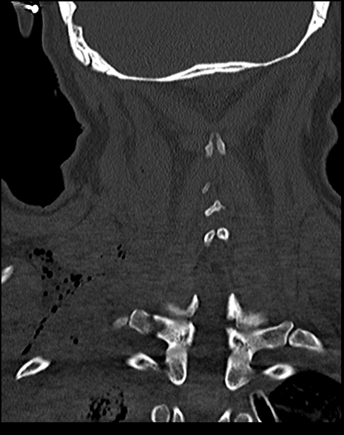Atlanto-occipital dissociation - Traynelis type 1 (Radiopaedia 87570-103948 Coronal bone window 45).jpg