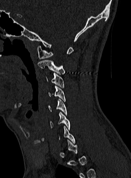 Atlantoaxial subluxation (Radiopaedia 44681-48450 Sagittal bone window 22).jpg
