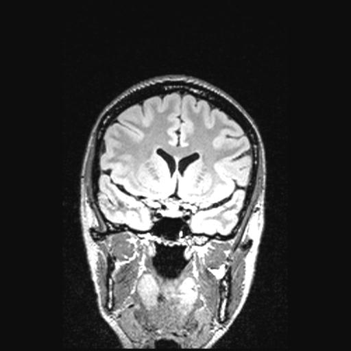 Atretic encephalocoele with inferior vermis hypoplasia (Radiopaedia 30443-31108 Coronal FLAIR 119).jpg