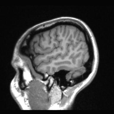 File:Atretic encephalocoele with inferior vermis hypoplasia (Radiopaedia 30443-31108 Sagittal T1 115).jpg