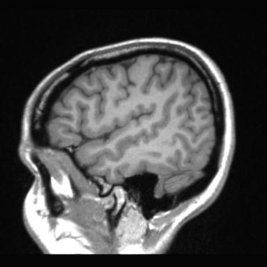 File:Atretic encephalocoele with inferior vermis hypoplasia (Radiopaedia 30443-31108 Sagittal T1 21).jpg