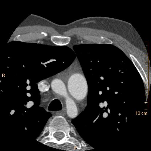 Atrial septal defect (upper sinus venosus type) with partial anomalous pulmonary venous return into superior vena cava (Radiopaedia 73228-83961 A 18).jpg