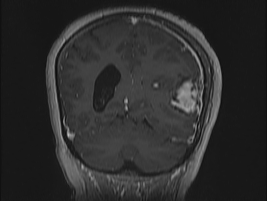 Atypical meningioma (Radiopaedia 62985-71406 Coronal T1 C+ 94).jpg