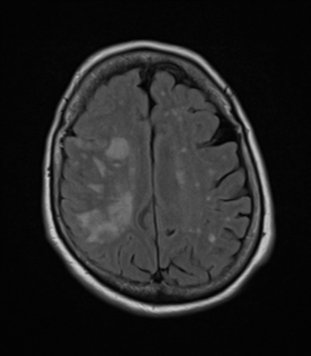 File:Atypical meningioma (WHO Grade II) (Radiopaedia 54742-60979 Axial FLAIR 20).png