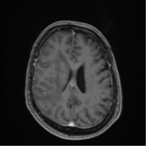Atypical meningioma (WHO Grade II) (Radiopaedia 54742-60979 Axial T1 C+ 44).png