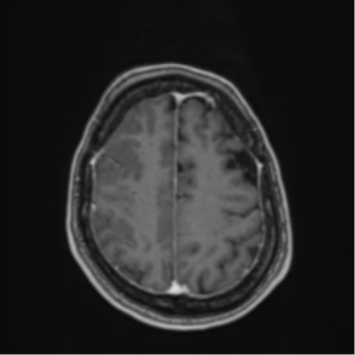 Atypical meningioma (WHO Grade II) (Radiopaedia 54742-60979 Axial T1 C+ 52).png
