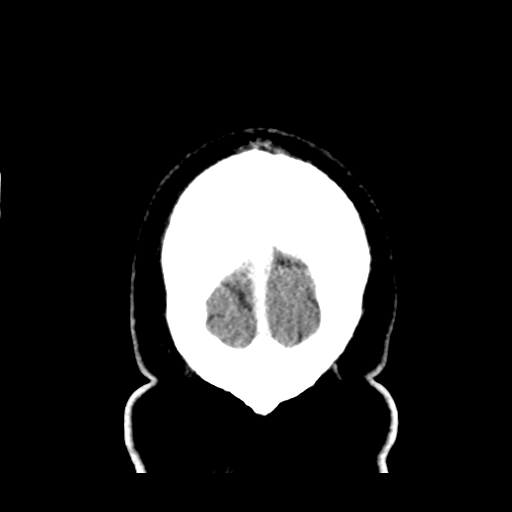Atypical meningioma (WHO grade II) with brain invasion (Radiopaedia 57767-64728 Coronal C+ 60).png