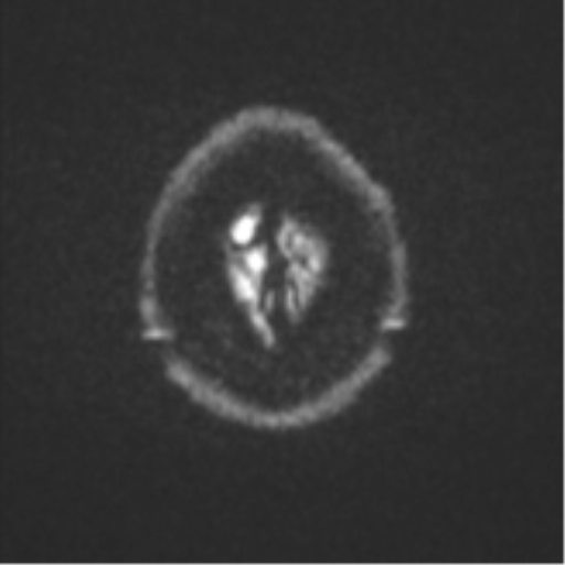 Atypical meningioma (WHO grade II) with brain invasion (Radiopaedia 57767-64729 Axial DWI 59).png