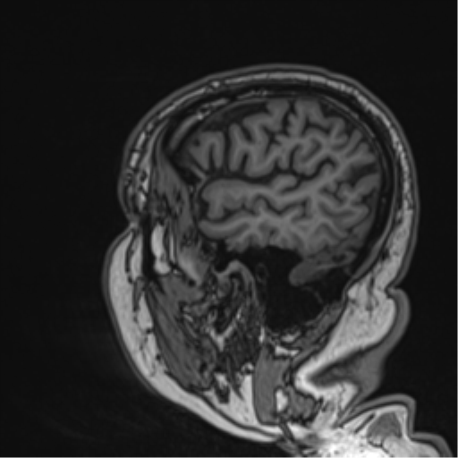 Atypical meningioma (WHO grade II) with brain invasion (Radiopaedia 57767-64729 Sagittal T1 18).png