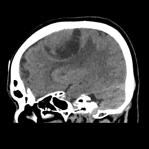 Atypical meningioma (WHO grade II) with osseous invasion (Radiopaedia 53654-59715 C 20).png