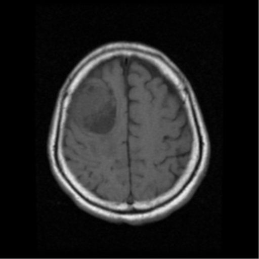 File:Atypical meningioma with skull invasion (Radiopaedia 34357-35648 Axial T1 17).png