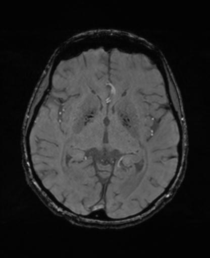 File:Autoimmune limbic encephalitis (Radiopaedia 30363-31005 SWI - magnitude 37).jpg