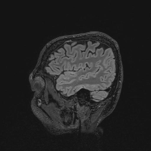 Autoimmune limbic encephalitis (Radiopaedia 30363-31005 Sagittal FLAIR 36).jpg