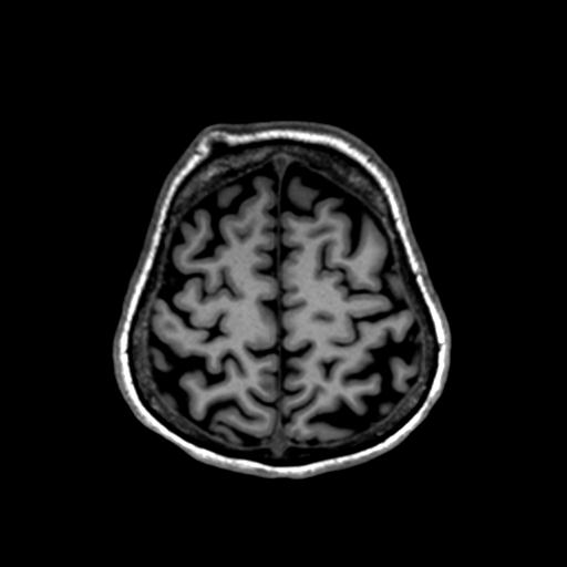 Autoimmune limbic encephalitis (Radiopaedia 30363-31005 T1 Axial 1mm 123).jpg