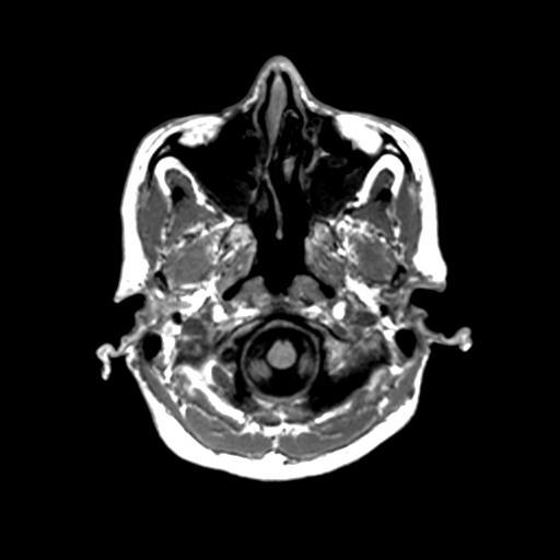 Autoimmune limbic encephalitis (Radiopaedia 30363-31005 T1 Axial 1mm 21).jpg