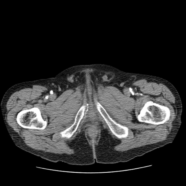 Autosomal dominant polycystic kidney disease (Radiopaedia 27851-28094 B 127).jpg